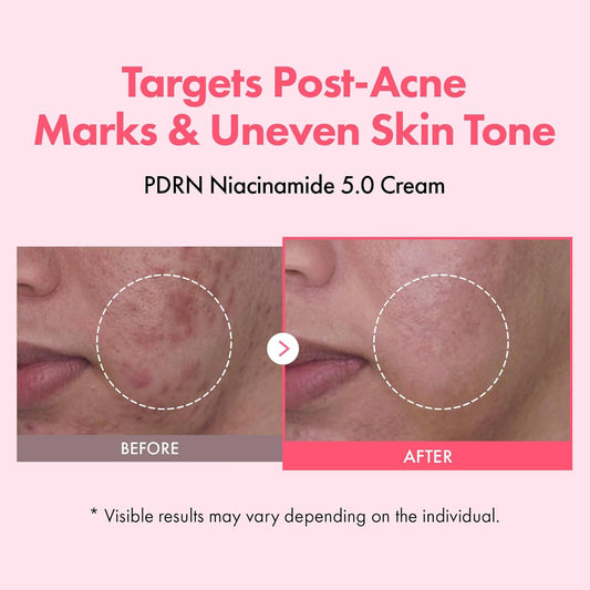 TOSOWOONG PDRN Niacinamide 5.0 Cream, Niacinamide 5% Dark Spot Remover for Face, Hyperpigmentation & Blemish Care, Salmon DNA Hydrating Moisturizer, Korean Skincare, 50ml / 1.69 fl. oz.